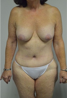 Tummy Tuck After Photo by Jonathan Hall, MD; Stoneham, MA - Case 24081