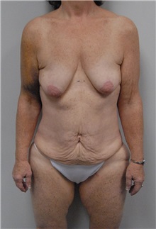 Tummy Tuck Before Photo by Jonathan Hall, MD; Stoneham, MA - Case 24081