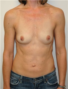 Breast Augmentation Before Photo by Jonathan Hall, MD; Stoneham, MA - Case 24082