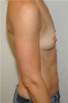 Breast Augmentation Before Photo by Jonathan Hall, MD; Stoneham, MA - Case 24082