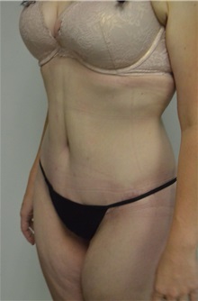 Body Contouring After Photo by Jonathan Hall, MD; Stoneham, MA - Case 26902