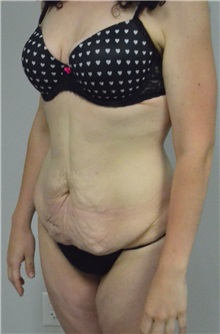Body Contouring Before Photo by Jonathan Hall, MD; Stoneham, MA - Case 26902