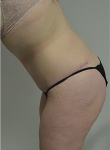 Body Contouring After Photo by Jonathan Hall, MD; Stoneham, MA - Case 26902