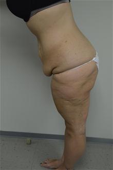 Body Contouring Before Photo by Jonathan Hall, MD; Stoneham, MA - Case 26904