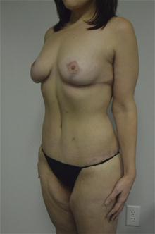 Body Contouring After Photo by Jonathan Hall, MD; Stoneham, MA - Case 26904