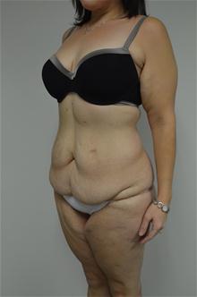 Body Contouring Before Photo by Jonathan Hall, MD; Stoneham, MA - Case 26904