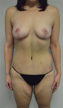 Body Contouring After Photo by Jonathan Hall, MD; Stoneham, MA - Case 26904