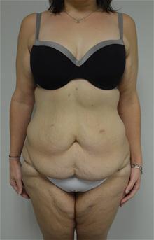 Body Contouring Before Photo by Jonathan Hall, MD; Stoneham, MA - Case 26904