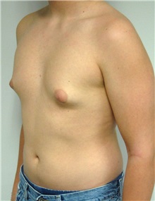 Male Breast Reduction Before Photo by Jonathan Hall, MD; Stoneham, MA - Case 26911