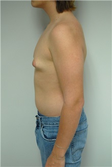 Male Breast Reduction Before Photo by Jonathan Hall, MD; Stoneham, MA - Case 26911