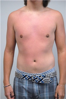 Male Breast Reduction After Photo by Jonathan Hall, MD; Stoneham, MA - Case 26911