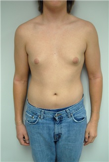 Male Breast Reduction Before Photo by Jonathan Hall, MD; Stoneham, MA - Case 26911