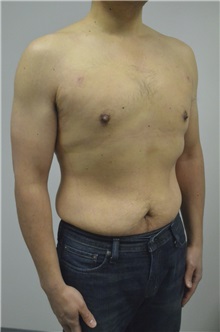 Male Breast Reduction After Photo by Jonathan Hall, MD; Stoneham, MA - Case 26913