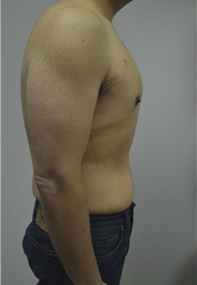 Male Breast Reduction After Photo by Jonathan Hall, MD; Stoneham, MA - Case 26913