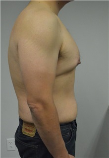 Male Breast Reduction Before Photo by Jonathan Hall, MD; Stoneham, MA - Case 26913