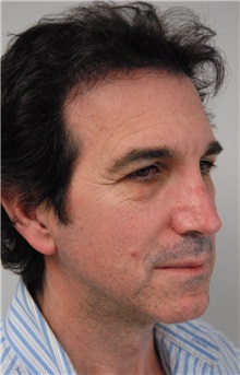 Eyelid Surgery Before Photo by Jonathan Hall, MD; Stoneham, MA - Case 26914