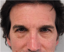 Eyelid Surgery Before Photo by Jonathan Hall, MD; Stoneham, MA - Case 26914