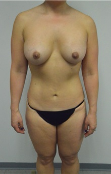 Liposuction After Photo by Jonathan Hall, MD; Stoneham, MA - Case 26915