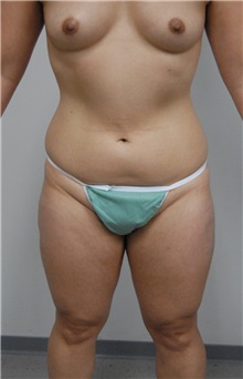 Liposuction Before Photo by Jonathan Hall, MD; Stoneham, MA - Case 26915