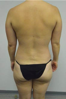 Liposuction After Photo by Jonathan Hall, MD; Stoneham, MA - Case 26915
