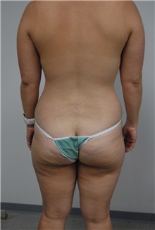 Liposuction Before Photo by Jonathan Hall, MD; Stoneham, MA - Case 26915