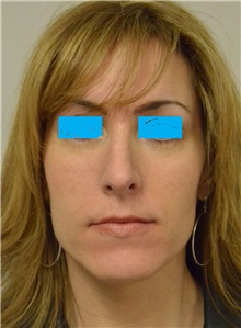 Rhinoplasty Before Photo by Jonathan Hall, MD; Stoneham, MA - Case 26917