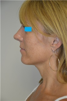 Rhinoplasty After Photo by Jonathan Hall, MD; Stoneham, MA - Case 26917