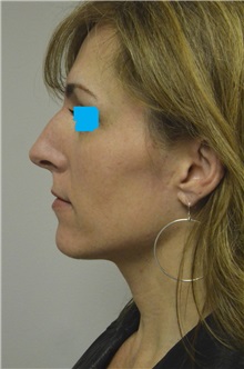 Rhinoplasty Before Photo by Jonathan Hall, MD; Stoneham, MA - Case 26917