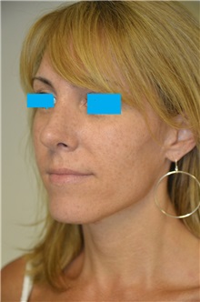 Rhinoplasty After Photo by Jonathan Hall, MD; Stoneham, MA - Case 26917