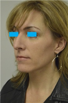 Rhinoplasty Before Photo by Jonathan Hall, MD; Stoneham, MA - Case 26917