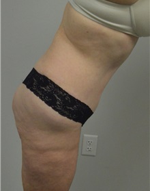 Tummy Tuck After Photo by Jonathan Hall, MD; Stoneham, MA - Case 26919