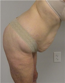 Tummy Tuck Before Photo by Jonathan Hall, MD; Stoneham, MA - Case 26919