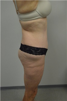 Tummy Tuck After Photo by Jonathan Hall, MD; Stoneham, MA - Case 26919