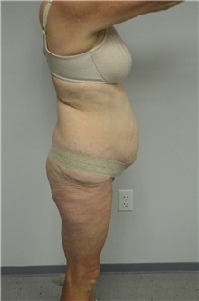 Tummy Tuck Before Photo by Jonathan Hall, MD; Stoneham, MA - Case 26919