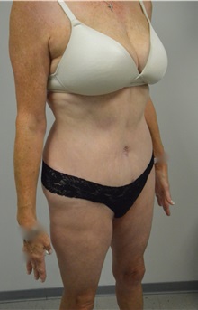 Tummy Tuck After Photo by Jonathan Hall, MD; Stoneham, MA - Case 26919