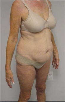 Tummy Tuck Before Photo by Jonathan Hall, MD; Stoneham, MA - Case 26919