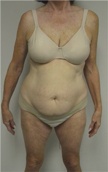 Tummy Tuck Before Photo by Jonathan Hall, MD; Stoneham, MA - Case 26919