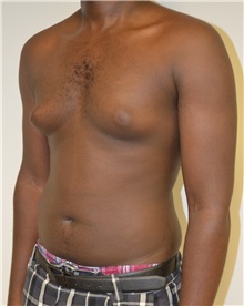 Male Breast Reduction Before Photo by Jonathan Hall, MD; Stoneham, MA - Case 26920