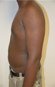 Male Breast Reduction After Photo by Jonathan Hall, MD; Stoneham, MA - Case 26920