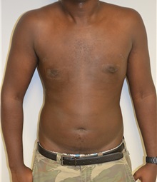 Male Breast Reduction After Photo by Jonathan Hall, MD; Stoneham, MA - Case 26920