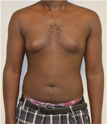 Male Breast Reduction Before Photo by Jonathan Hall, MD; Stoneham, MA - Case 26920