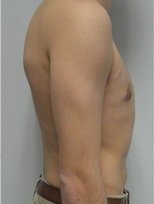 Male Breast Reduction After Photo by Jonathan Hall, MD; Stoneham, MA - Case 26921