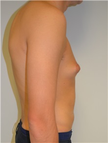 Male Breast Reduction Before Photo by Jonathan Hall, MD; Stoneham, MA - Case 26921