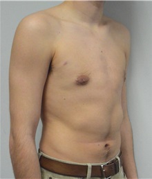 Male Breast Reduction After Photo by Jonathan Hall, MD; Stoneham, MA - Case 26921