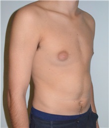 Male Breast Reduction Before Photo by Jonathan Hall, MD; Stoneham, MA - Case 26921