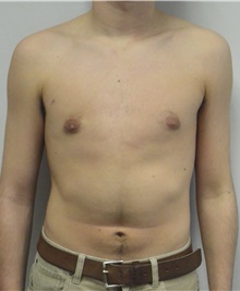 Male Breast Reduction After Photo by Jonathan Hall, MD; Stoneham, MA - Case 26921