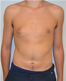 Male Breast Reduction Before Photo by Jonathan Hall, MD; Stoneham, MA - Case 26921