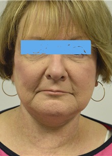 Facelift After Photo by Jonathan Hall, MD; Stoneham, MA - Case 27115