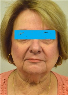 Facelift Before Photo by Jonathan Hall, MD; Stoneham, MA - Case 27115