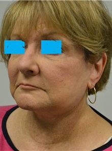 Facelift After Photo by Jonathan Hall, MD; Stoneham, MA - Case 27115